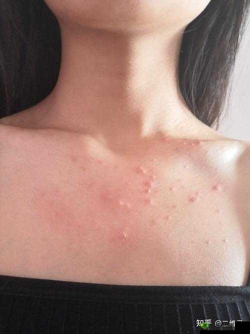 女生胸前长疙瘩,竟是因为这个